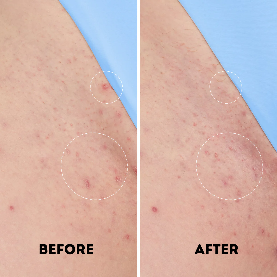 Zavarry® Ingrown Hair Treatment